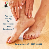 Endovenous laser ablation therapy